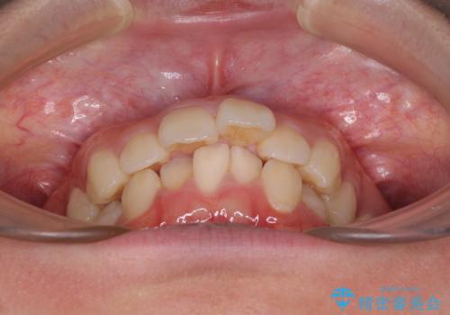 飛び出した上顎前歯 ワイヤー装置にて抜歯矯正治療の治療前