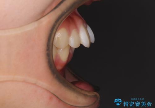 飛び出した上顎前歯 ワイヤー装置にて抜歯矯正治療の治療前