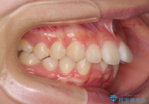 飛び出した上顎前歯 ワイヤー装置にて抜歯矯正治療の治療前