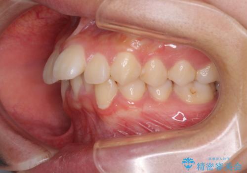 飛び出した上顎前歯 ワイヤー装置にて抜歯矯正治療の治療前