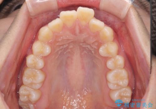 飛び出した上顎前歯 ワイヤー装置にて抜歯矯正治療の治療前