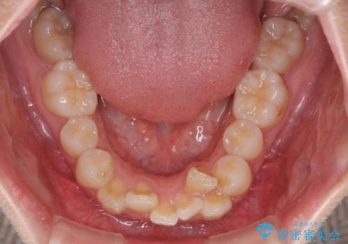 飛び出した上顎前歯 ワイヤー装置にて抜歯矯正治療の治療前