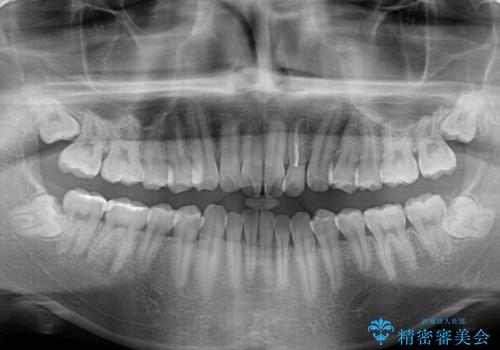クロスバイトを楽して治す ワイヤー装置にて矯正治療の治療前