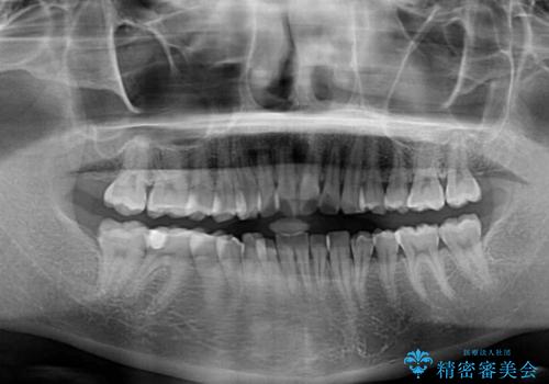 前歯のデコボコをインビザラインできれいに整えるの治療前