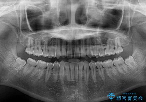 前歯のすきっ歯を治したい インビザラインによる矯正治療の治療前