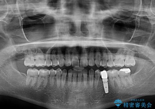 前歯を綺麗にしたい 部分矯正とセラミック治療の治療前