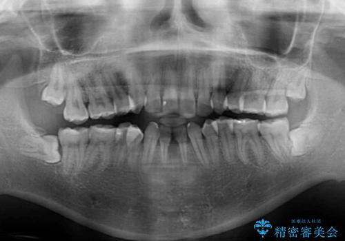 後戻りの再矯正 ワイヤー装置でデコボコと隙間を改善の治療前