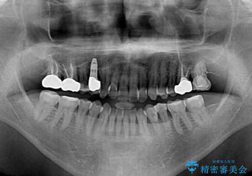 今からでも綺麗な歯並びを手に入れたい 40代男性のワイヤー矯正の治療前