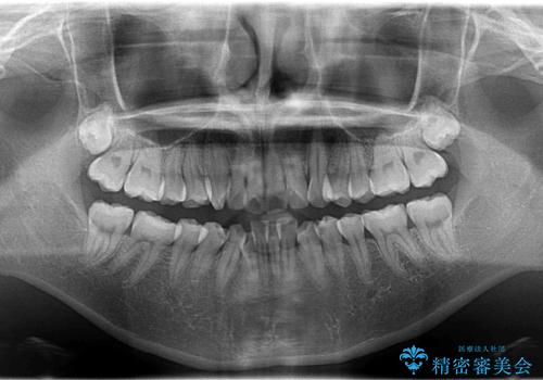 【インビザライン】抜歯矯正で口元も改善の治療前