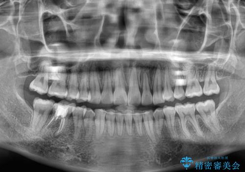前歯のデコボコをインビザラインできれいに整えるの治療後