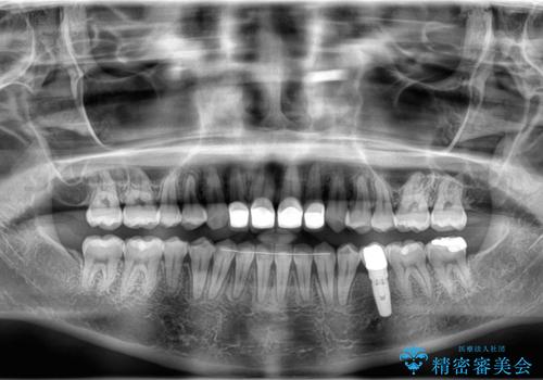 前歯を綺麗にしたい 部分矯正とセラミック治療の治療後