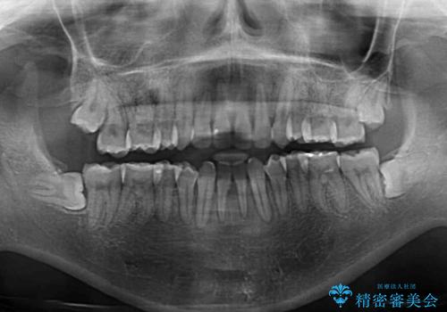後戻りの再矯正 ワイヤー装置でデコボコと隙間を改善の治療後