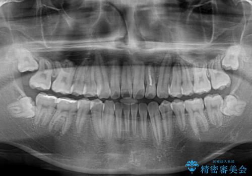 クロスバイトを楽して治す ワイヤー装置にて矯正治療の治療後