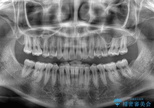 前歯のすきっ歯を治したい　インビザラインによる矯正治療の治療後