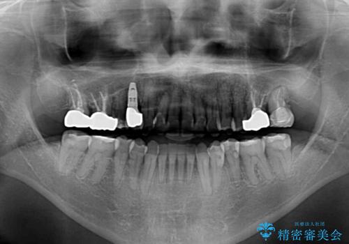 今からでも綺麗な歯並びを手に入れたい 40代男性のワイヤー矯正の治療後