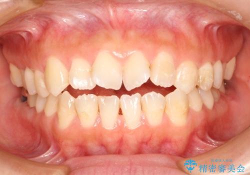 オープンバイト、噛んだ時に前歯が閉じない(開咬)をインビザラインでの症例 治療前