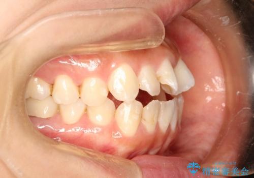 オープンバイト、噛んだ時に前歯が閉じない(開咬)をインビザラインでの治療前