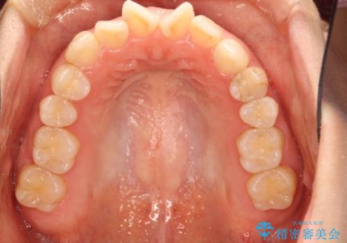 オープンバイト、噛んだ時に前歯が閉じない(開咬)をインビザラインでの治療前