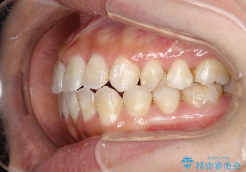 オープンバイト、噛んだ時に前歯が閉じない(開咬)をインビザラインでの治療中