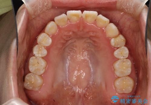 オープンバイト、噛んだ時に前歯が閉じない(開咬)をインビザラインでの治療中
