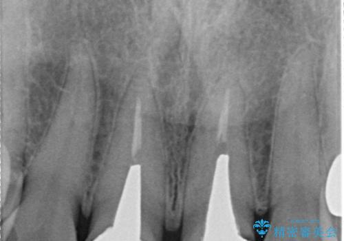 【審美修復】被せ物のみの治療の治療前