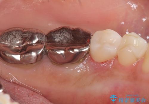 【セラミックインレー】銀の詰め物を白くしていきたいの治療後