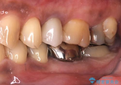 【セラミックインレー】銀の詰め物を白くしていきたいの治療前