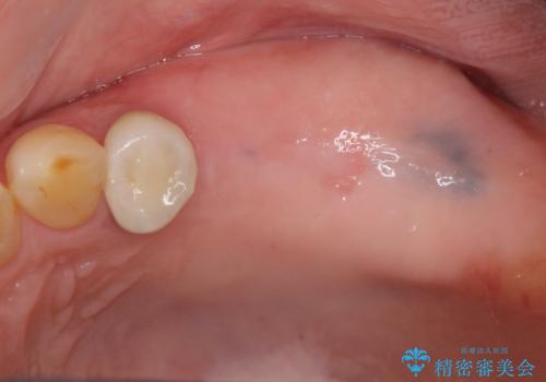 奥歯がない　咬合力を回復するインプラント治療の治療中