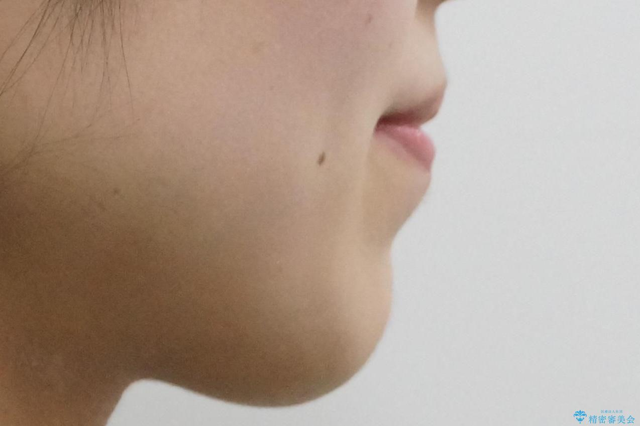 八重歯を非抜歯で マウスピースで治療 奥歯を後ろに下げてすき間を確保の治療後(顔貌)