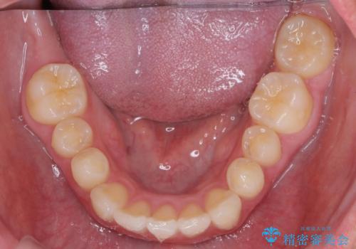 [ ワイヤー小矯正+マウスピース矯正 ]  前歯のねじれを短期間で治したいの治療後
