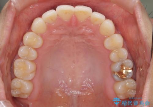 [ インビザライン ]  目立たないマウスピース矯正で、前歯のがたつきをきれいにしたいの治療中