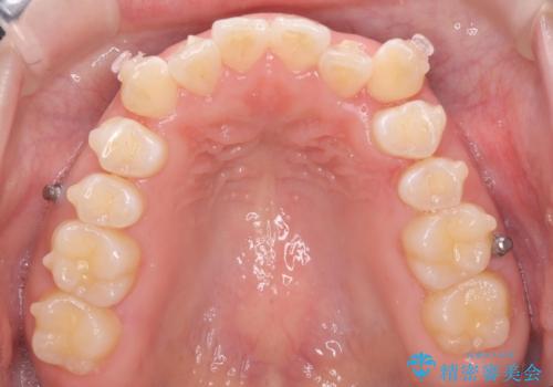 八重歯を非抜歯で マウスピースで治療 奥歯を後ろに下げてすき間を確保の治療中