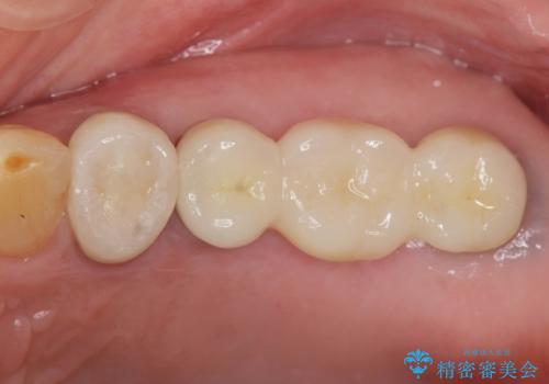 奥歯がない　咬合力を回復するインプラント治療の治療後