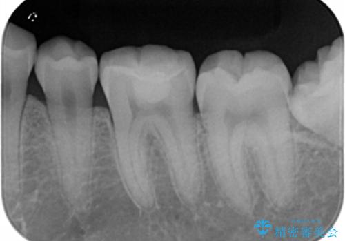 虫歯部分を白い詰め物で治したいの治療後