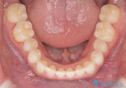 八重歯を非抜歯で マウスピースで治療 奥歯を後ろに下げてすき間を確保の治療後
