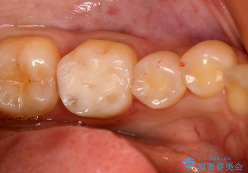 虫歯部分を白い詰め物で治したいの症例 治療後