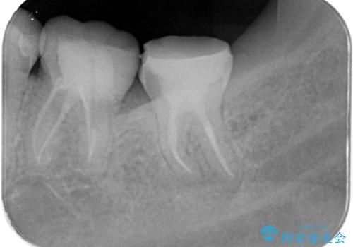 【根管治療】他院でインプラントの提案があった。奥歯が痛い。の治療中