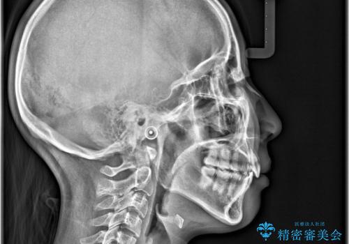 【インビザライン】抜歯矯正で口元も改善の治療後