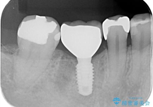 虫歯で失ってしまった奥歯、インプラント治療で再び噛めるように!の治療後