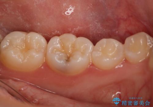 虫歯部分を白い詰め物で治したいの治療前