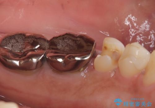 【セラミックインレー】銀の詰め物を白くしていきたいの治療中