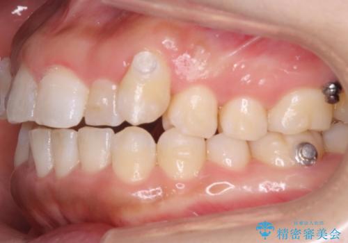 八重歯を非抜歯で　マウスピースで治療　奥歯を後ろに下げてすき間を確保の治療中