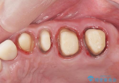 銀歯を外し、インプラントを入れたいの治療中