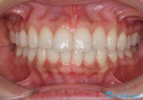 [ インビザライン ]  目立たないマウスピース矯正で、前歯のがたつきをきれいにしたいの症例 治療後