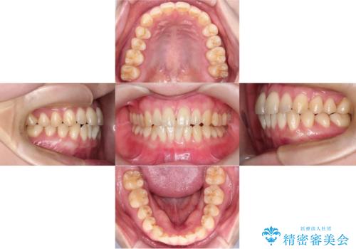 【インビザライン、10ヵ月で矯正終了!】下の前歯が斜めになっているのを治したい!の治療前