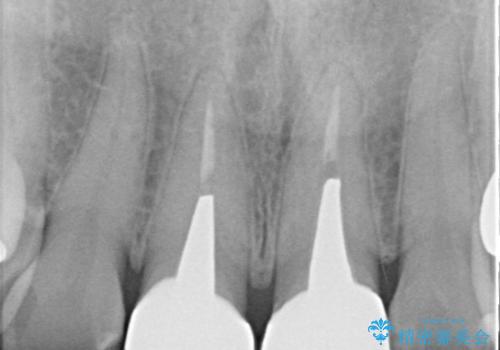 【審美修復】被せ物のみの治療の治療後
