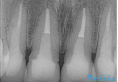 黒っぽい歯ぐきを改善したい　メタルフリーセラミック治療