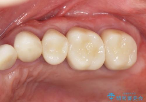 銀歯を外し、インプラントを入れたいの治療後