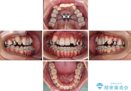 八重歯とオープンバイト　急速拡大装置を用いた矯正治療の治療中
