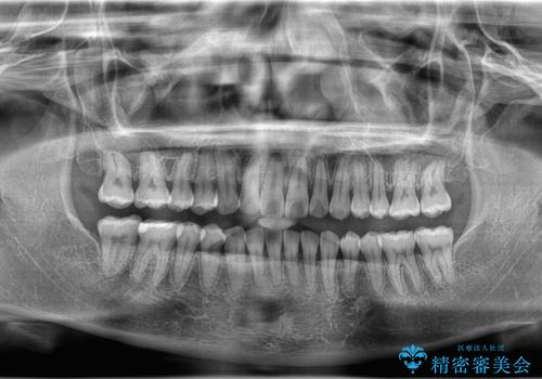 【インビザライン、10ヵ月で矯正終了!】下の前歯が斜めになっているのを治したい!の治療後